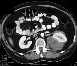 Renal Lymphoma - CTisus CT Scan