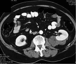 Renal Lymphoma - CTisus CT Scan