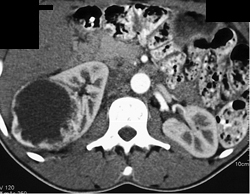 Cystic Renal Cell Carcinoma (RCC) - CTisus CT Scan