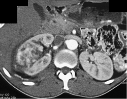 Cystic Renal Cell Carcinoma (RCC) - CTisus CT Scan