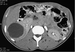 Cystic Renal Cell Carcinoma (RCC) - CTisus CT Scan