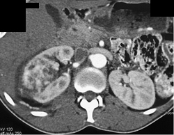 Cystic Renal Cell Carcinoma (RCC) - CTisus CT Scan