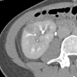 Acute Pyelonephritis - CTisus CT Scan