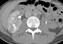 Acute Pyelonephritis - CTisus CT Scan