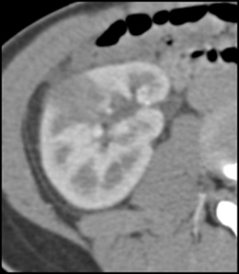 Acute Pyelonephritis - CTisus CT Scan