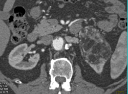 Renal Angiomyolipoma (AML) - CTisus CT Scan