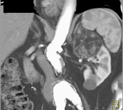 Renal Angiomyolipoma (AML) - CTisus CT Scan