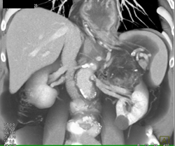 Renal Angiomyolipoma (AML) - CTisus CT Scan