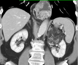 Renal Angiomyolipoma (AML) - CTisus CT Scan