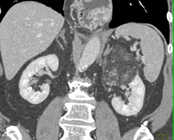 Renal Angiomyolipoma (AML) - CTisus CT Scan