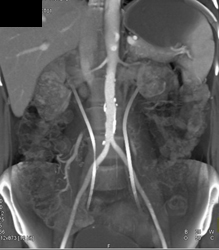 Retroperitoneal Fibrosis With Stents in Both Renal Pelves, Ureters, and Into Bladder - CTisus CT Scan