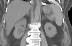 Cystic Lesion Pushes on Renal Pelvis and Distorts the Renal Pelvis - CTisus CT Scan