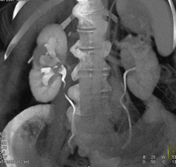 Acute Pyelonephritis - CTisus CT Scan