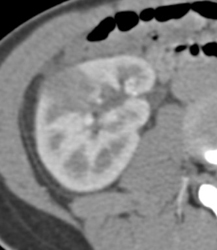 Acute Pyelonephritis - CTisus CT Scan