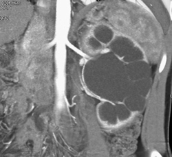 Ureteropelvic Junction (UPJ) Due to Crossing Artery With Dilated Calyces - CTisus CT Scan