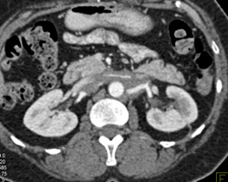 Retroperitoneal Fibrosis With Vessel Encasement - CTisus CT Scan