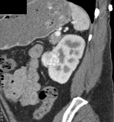 Renal Cell Carcinoma - CTisus CT Scan