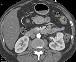 Renal Cell Carcinoma - CTisus CT Scan