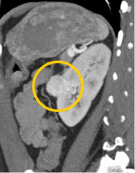 Renal Cell Carcinoma - CTisus CT Scan