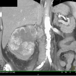 Renal Cell Carcinoma Invades the Inferior Vena Cava (IVC) - CTisus CT Scan