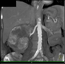 Renal Cell Carcinoma Invades the Inferior Vena Cava (IVC) - CTisus CT Scan