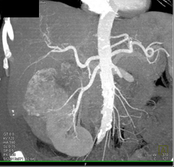 Renal Cell Carcinoma Invades the Inferior Vena Cava (IVC) - CTisus CT Scan