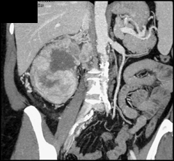 Renal Cell Carcinoma Invades the Inferior Vena Cava (IVC) - CTisus CT Scan