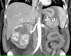 Renal Cell Carcinoma Invades the Inferior Vena Cava (IVC) - CTisus CT Scan