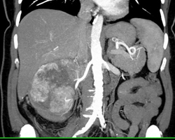 Renal Cell Carcinoma Invades the Inferior Vena Cava (IVC) - CTisus CT Scan