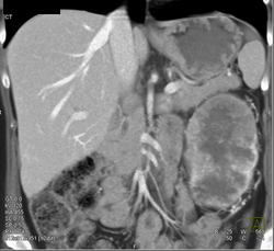 Renal Cell Carcinoma With Para-aortic Nodes - CTisus CT Scan