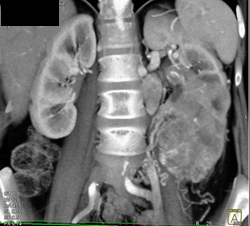 Vascular Renal Cell Carcinoma - CTisus CT Scan