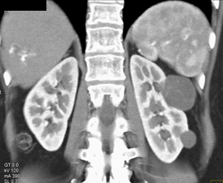 Renal Cysts on VRT and MIP - CTisus CT Scan