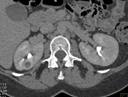 Multiple Bilateral Renal Cell Carcinomas - CTisus CT Scan