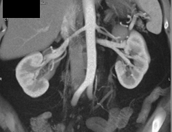 Prehilar Branching of the Renal Artery - CTisus CT Scan