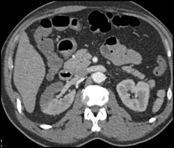 Infarction of Right Kidney - CTisus CT Scan