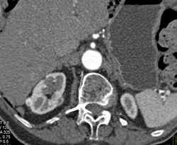 Multiple Small Renal Cell Carcinomas - CTisus CT Scan