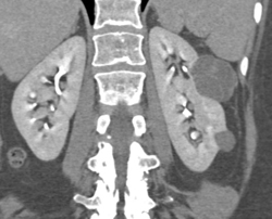 Bosniak 2 Cysts - CTisus CT Scan