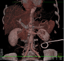 Drainage of Perirenal Abscess - CTisus CT Scan