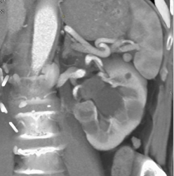 Renal Cell Carcinoma-in Multiple Phases - CTisus CT Scan