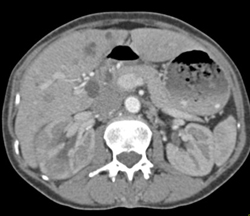 Acute Pyelonephritis- Right - CTisus CT Scan