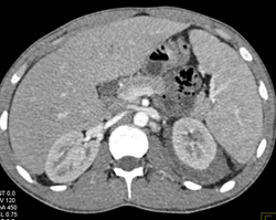 Perirenal Hematoma - CTisus CT Scan