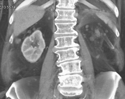 Carcinomatosis Due to Renal Cancer - CTisus CT Scan