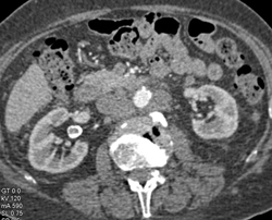 Right Renal Artery Aneurysm - CTisus CT Scan