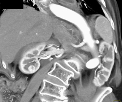 Small Right Renal Cell Carcinoma (RCC) - Vascular - CTisus CT Scan