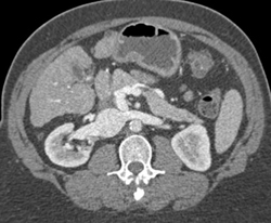 Portal Hypertension With Shunting to Right Renal Vein - CTisus CT Scan