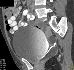 Nice Ectopic Entry of Ureter Into Bladder in 3D - CTisus CT Scan