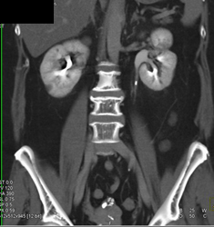 Stone in Left Ureter - CTisus CT Scan