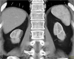 Scar Right Kidney - CTisus CT Scan