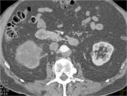 Transitional Cell Cancer (TCC) of Right Kidney - CTisus CT Scan