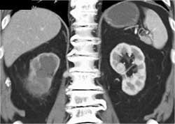 Transitional Cell Cancer (TCC) of Right Kidney - CTisus CT Scan